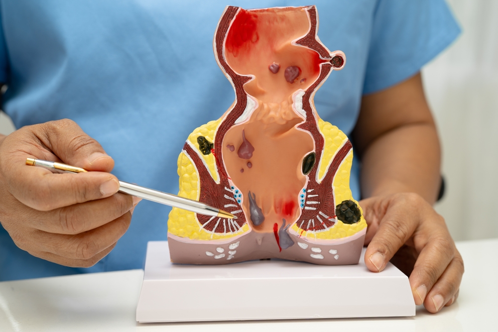 Hemorrhoids affect general health