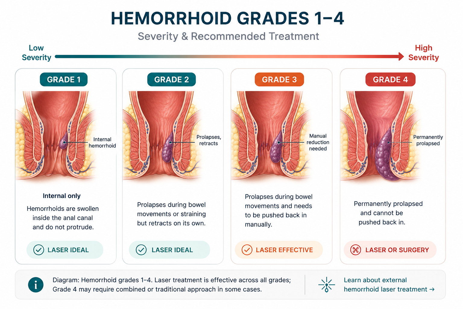 Diagram: Hemorrhoid grades 1–4. Laser treatment is effective across all grades; Grade 4 may require combined or traditional approach in some cases.
