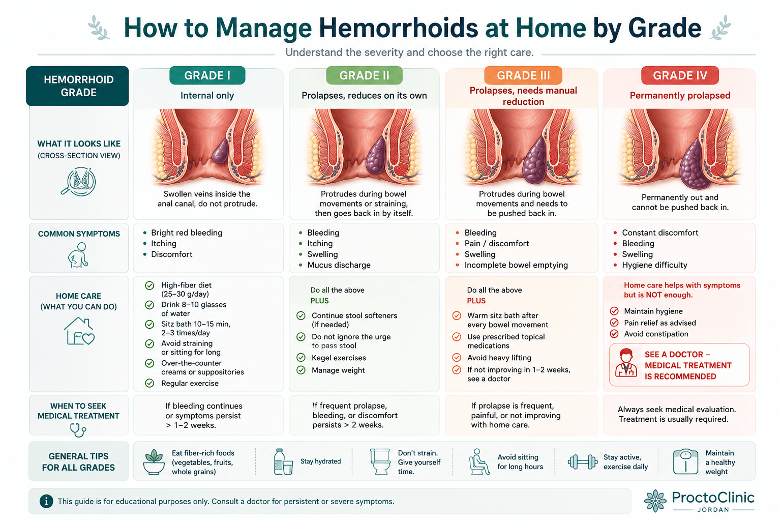 How to manage hemorrhoids at home by grade: diagram showing Grade I–IV hemorrhoid severity and matching home care versus medical treatment options
